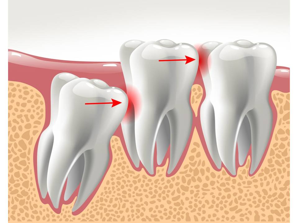 Wisdom Tooth Removal