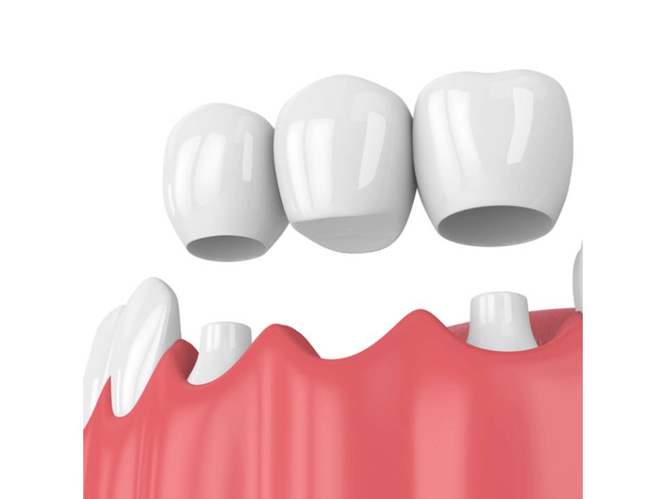 Dental Bridge